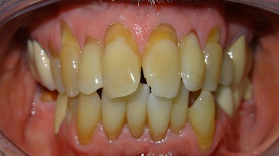 Full Mouth Restoration