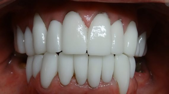 Full Mouth Restoration