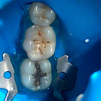 Amalgam Filling Removal