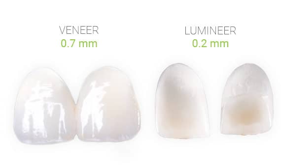 Lumineers and Veneers Differences