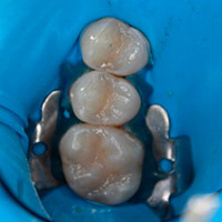 Mercury Removal Smart Protocol