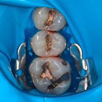 Mercury Removal Smart Protocol