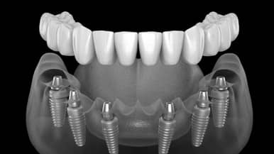 3 on 6 Dental Implants - treatment alternative