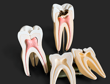 Root Canal Therapy in Mexico
