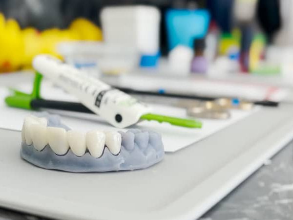 top 5 factors that influence veneers cost