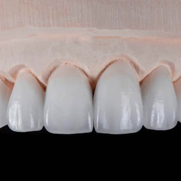 dental veneers clouse up mexico