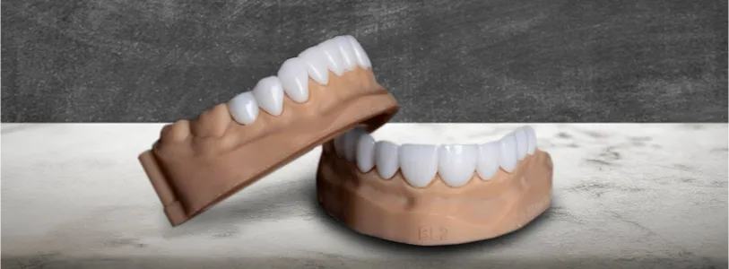 dental lumeneers teeth