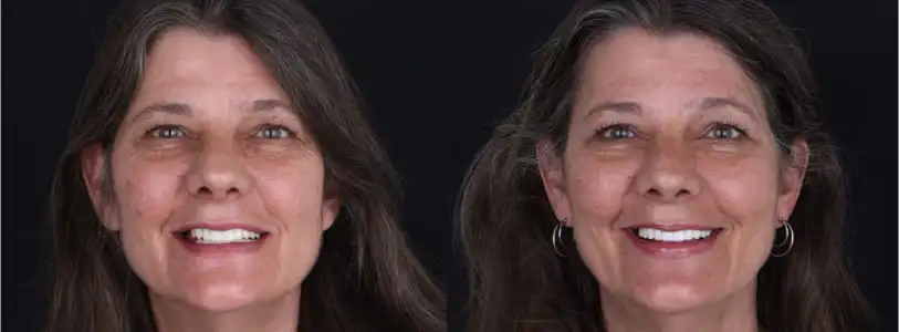 Cancun Dental Specialists is one of the best options to get a dental implant because it combines quality, technology, affordability and beautiful views